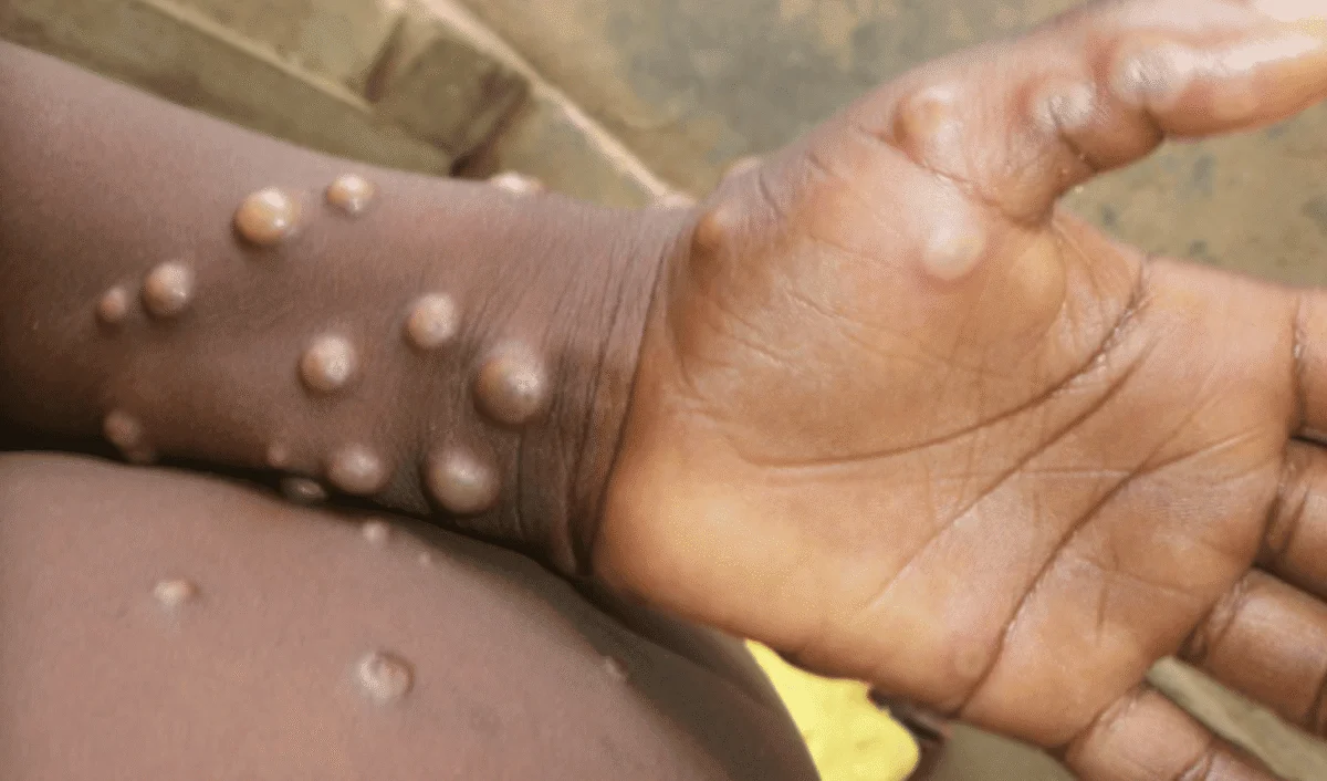 Raised, fluid-filled monkeypox skin lesions and blisters on a person's arm and hand.