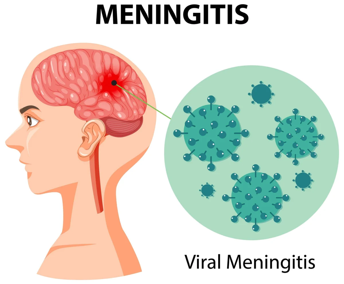 Diagram titled Meningitis illustrating brain inflammation alongside magnified viral meningitis particles.