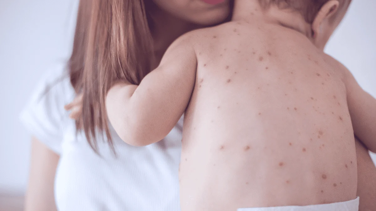 A mother holding a child with a red skin rash across their back.